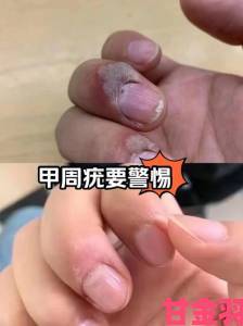 一夫一妻HPV传播的深层逻辑：夫妻预防必须把握的关键点