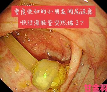 绑起来往屁股眼灌肠用牛奶操作不当会引发哪些健康问题